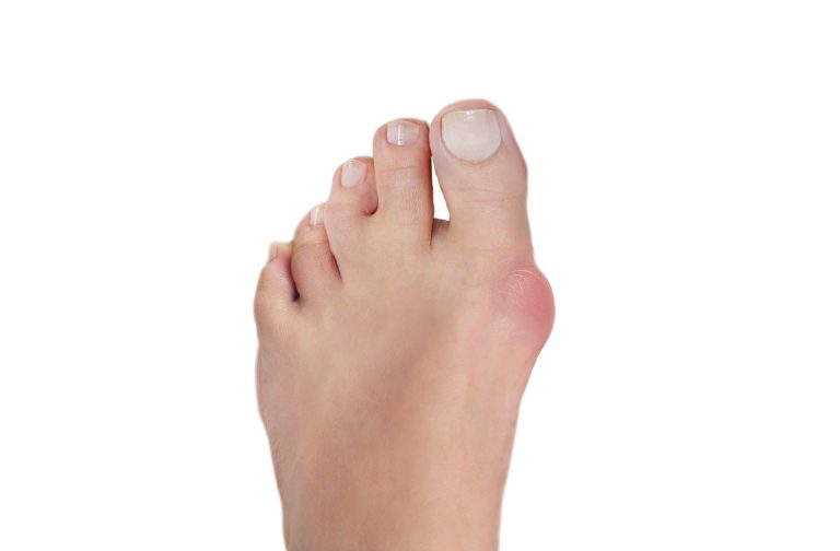 Bunions - What Are They & How Can We Help - The Healthcare Hub