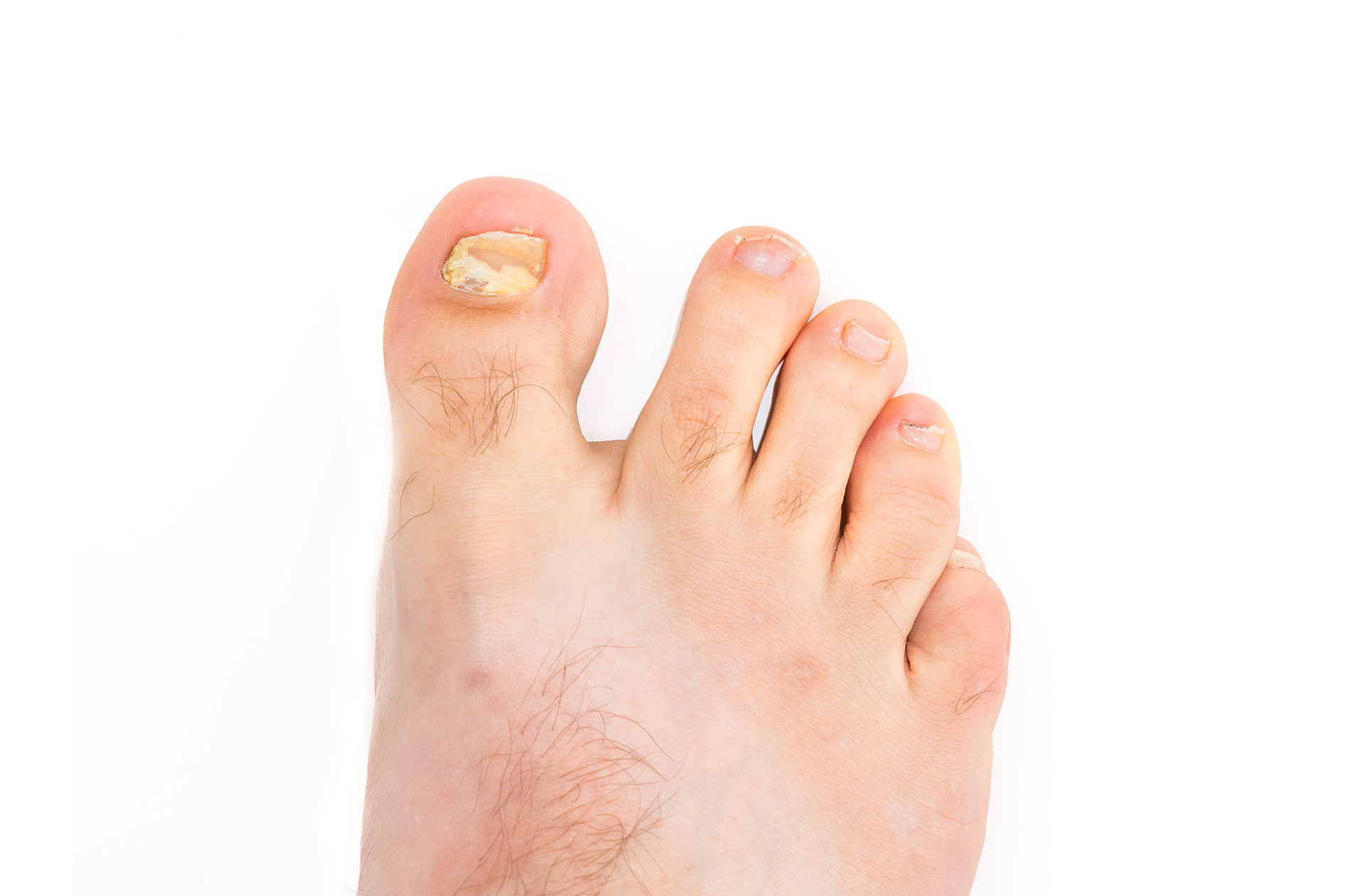 Thickened Toenails - Why Do I Have Them? - The Healthcare Hub